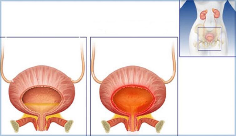The bladder is normal with signs of inflammation due to cystitis
